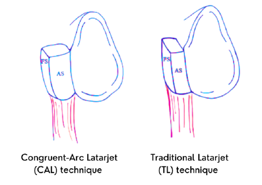 CAL-TL