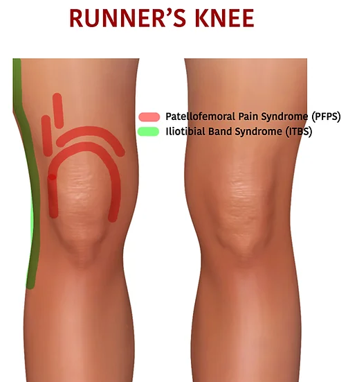 Arthritis