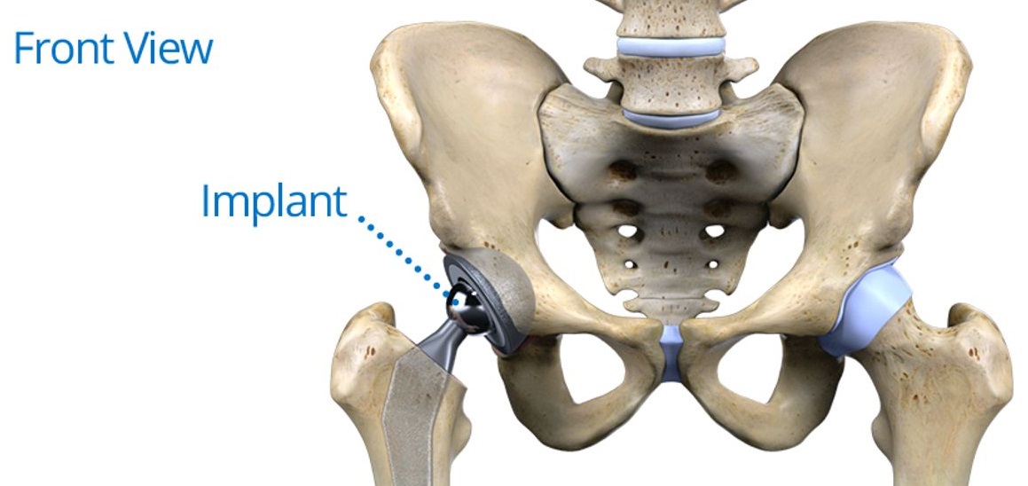 Hip Replacement in Meerut